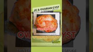 Ovarian Cyst amp JC cancer organic [upl. by Ahsemot647]