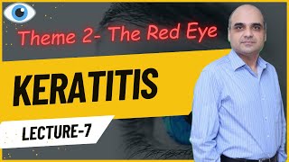 Keratitis Lecture 7 [upl. by Camp412]