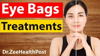 Eye Bags Treatments  Natural Remedies in Just 20 Minutes [upl. by Nnaeirb]