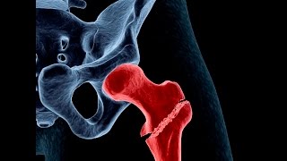 Treating Osteoporosis or Low Bone Density [upl. by Adnilemreh]