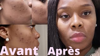 COMMENT se débarrasser des BOUTONS et TACHES sur le visage  ROUTINE Ducray  Samantha MK [upl. by Lozar]