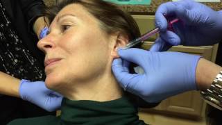 Juvederm Volbella Injection for Ear Lobe Rejuvenation [upl. by Lynde]