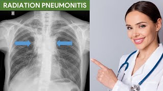 Radiation Pneumonitis [upl. by Hannibal]