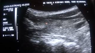 ultrasound  PARATHYROID GLAND [upl. by Stormi]