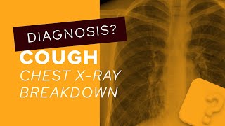 Chest XRay breakdown a guide to bronchiectasis on imaging [upl. by Eikcuhc]