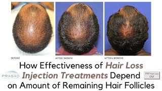 Why PRP and PRP ACell Treatments for Hair Loss Need Viable Hair Follicles to Work [upl. by Dutch]