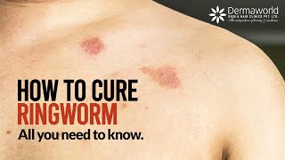 Type of Ringworm  How to cure Ringworm  All you need to know about Ringworms  Dr Rohit Batra [upl. by Alver]