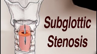 Adult Subglottic Stenosis Treatment [upl. by Fleurette910]