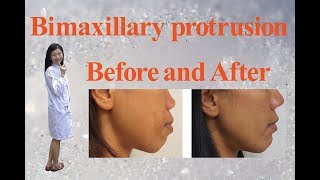 Bimaxillary protrusion before and after [upl. by Marla]