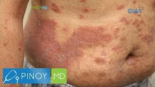 Pinoy MD Ano nga ba ang Psoriasis [upl. by Okiek]