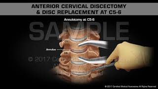 Anterior Cervical Discectomy amp Disc Replacement at C56 [upl. by Rednael]