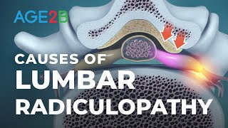 What Causes Lumbar Radiculopathy  Lumbar Nerve Roots  Disc Bulge [upl. by Yot]