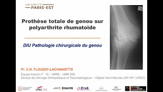 12  PTG sur polyarthrite rhumatoïde [upl. by Aitnohs]