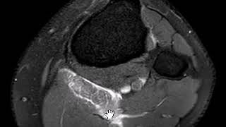 Plantaris musle rupture [upl. by Reuven]