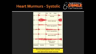 Heart Murmurs  Aortic Stenosis [upl. by Wycoff]