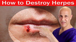 How to Destroy HERPES  Dr Mandell [upl. by Kermit712]