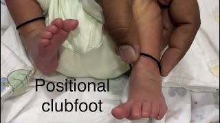 Ask your doctor 3 what is Positional clubfoot treatment childorthocare [upl. by Mcdermott]