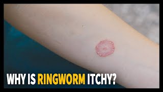 All you need to know about Ringworm Why is it itchy [upl. by Moynahan]