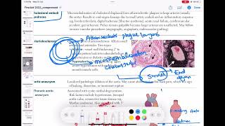 Cholesterol emboli syndrome cardiology 69  First Aid USMLE Step 1 in UrduHindi [upl. by Ellehsad542]