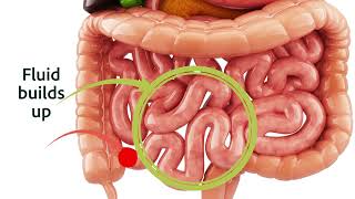 Osmotic laxatives exhibit a linear dose response [upl. by Retxab]