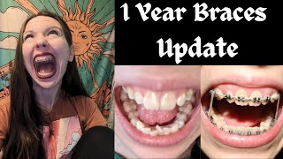 1 YEAR ADULT BRACES UPDATE🦷Progress Elastics Current Routine  More [upl. by Treblihp]