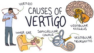 Understanding the Causes of Vertigo [upl. by Nylloc]