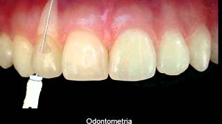 TRATAMENTO ENDODONTICO [upl. by Chevalier973]