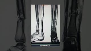 Tibia ap lateral view Fracture anatomy xraytechnician xray xrayinspection [upl. by Yrneh]