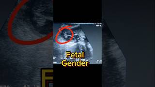 Easy Fetal Ultrasound  Gender Revealing  Anomaly Scan  3rd Trimester Third [upl. by Glenine]