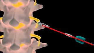 Lumbar Radiofrequency treatment [upl. by Sliwa]