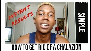 HOW TO GET RID OF A CHALAZION  instant results [upl. by Bogusz]