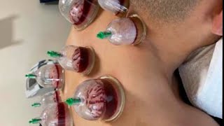 viralvideo vlog cuppingtherapy hyderabadtelangana [upl. by Cutter]