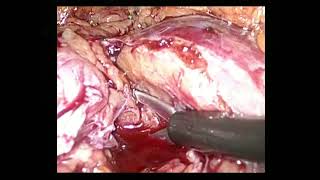 Laparoscopic partial nephrectomy Twist technique [upl. by Floria688]