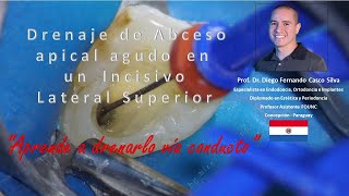 Drenaje de absceso apical agudo via conducto de diente anterosuperior [upl. by Idnem]