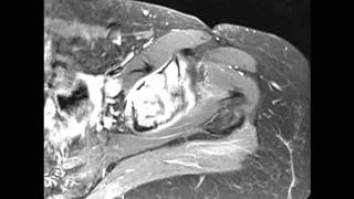 Chondrosarcoma of the Acetabulum [upl. by Chere]