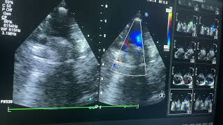 Truncus arteriosus  tricuspid valve attesia [upl. by Yeroc]