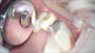 Subgingival prep technique [upl. by Crawley664]