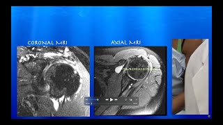 Ultrasound of SubcoracoidSubdeltoid Bursitis amp Partial vs SmallFull Thickness Supraspinatus Tear [upl. by Aber]