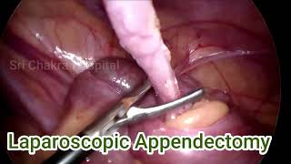 Laparoscopic Appendectomy  With In 4 Minutes  Step By Steps  Day 60100 [upl. by Hamon97]