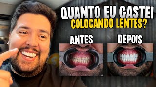 QUANTO CUSTA COLOCAR LENTE DE PORCELANA NOS DENTES [upl. by Amsa]