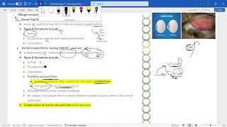 Ophthalmology 9 – Conjunctival Diseases [upl. by Leupold]