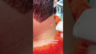 Laser Hair Removal getsmarthairclub viralvideo beauty [upl. by Marie-Jeanne757]