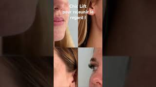 Chic Lift pour rajeunir le regard  Par le Dr Raspaldo medecineesthetique acidehyaluronique [upl. by Syned313]