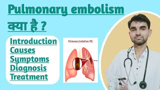 Pulmonary embolism in Hindi  Causes  Sign and Symptoms  Treatment of Pulmonary Embolism [upl. by Hcurob]