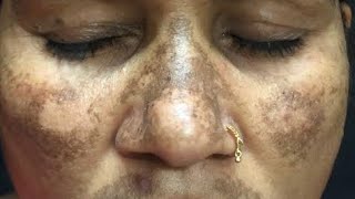 Treatment of Stubborn Melasma or Resistant Melasma  Kayakalp Laser Clinic [upl. by Oivaf]