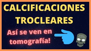 CALCIFICACIONES TROCLEARES en tomografía👁️ [upl. by Yarahs954]