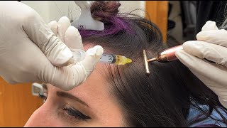 PRP Injections for Hair Loss [upl. by Nairret354]