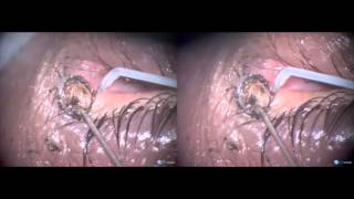 Large naevus on punctum and canaliculus removal with Fugo blade [upl. by Budge568]