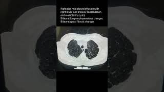 Right side mild pleural effusion with right lower lobe areas of consolidationpulmonologist [upl. by Halona]