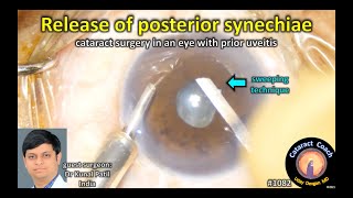 CataractCoach 1082 fixing posterior synechiae during cataract surgery [upl. by Teeter]